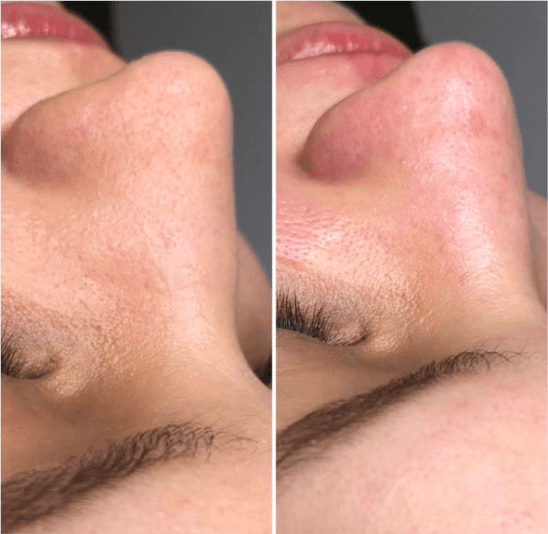 Limpeza de pele antes e depois