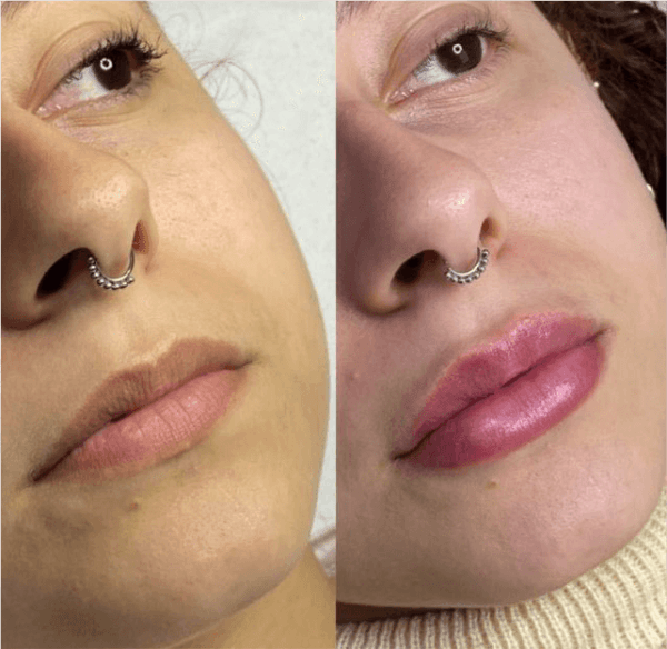 Preenchimento labial antes e depois 1