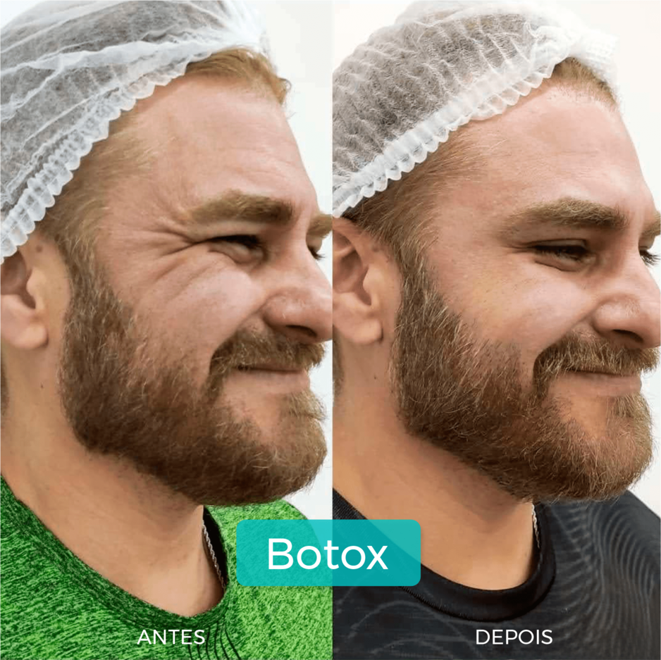 botox 1