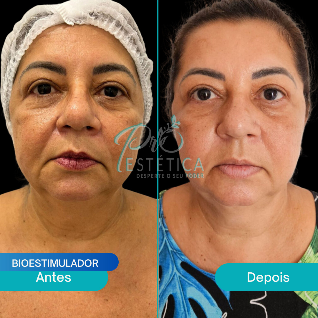 Rejuvenescimento Labial - Gloss Labial - Hidratação Labial - Volume Labial - Lábios mais Cheios - Lip Plumper Aumentador de Lábios - Brilho Labial Rejuvenescedor - Lábios mais Suaves - Tratamento Labial Anti-Envelhecimento - Rejuvenescimento Facial - Tratamento Facial Rejuvenescedor - Renovação da Pele do Rosto - Rejuvenescimento da pele Facial - Terapia Facial Anti-Envelhecimento - Revitalização Facial - Melhoria da Elasticidade da Pele - Redução de Rugas e Linhas Finas - Aumento da Firmeza da Pele - Restauração do Brilho e da Juventude da Pele Facial