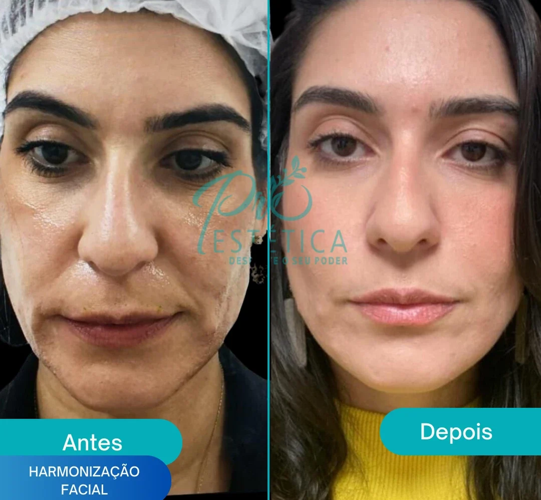 harmonizacao_facial_2_ harmonizacao_facial_2_