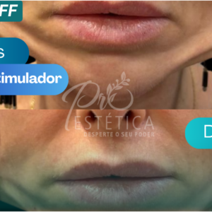 Bioestimulador Radiesse