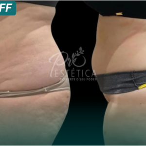 CMSlim – 10 sessões