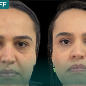 Laser Fotona a partir de R$ 1.500