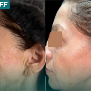 Ultraformer MPT Full Face