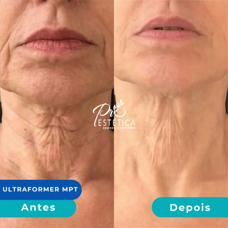 antes_e_depois_10__1x