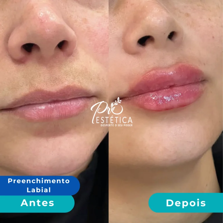 antes_e_depois_1__1x